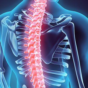 Spinal Cord Stimulation for Back Pain